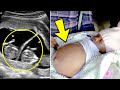 Baby Girl Born Pregnant with Twins and doctors were left speechless!