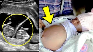 Baby Girl Born Pregnant with Twins and doctors were left speechless!