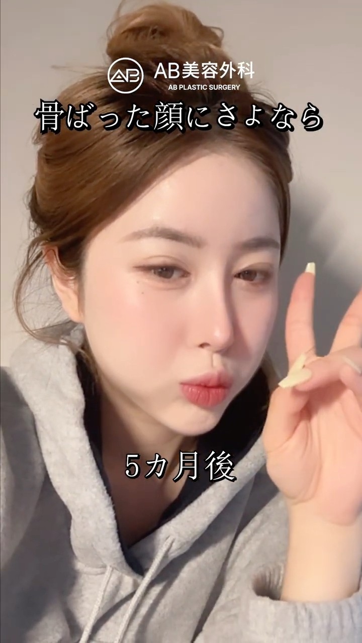 鼻整形だけで、顔全体の雰囲気が変わった #shorts