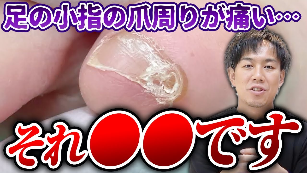 足の小指の爪周りが痛い原因を解明！副爪の正体と痛みの対処法 - YouTube