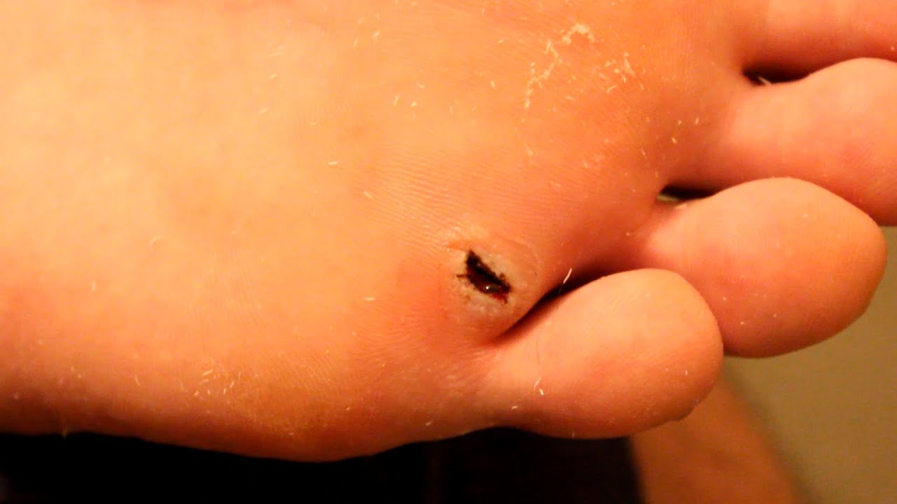 Wart surgically Removed and Cauterized YouTube