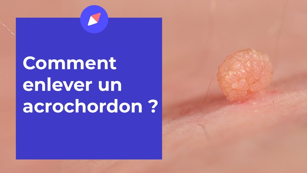 Acrochordons : comment s'en débarrasser ?