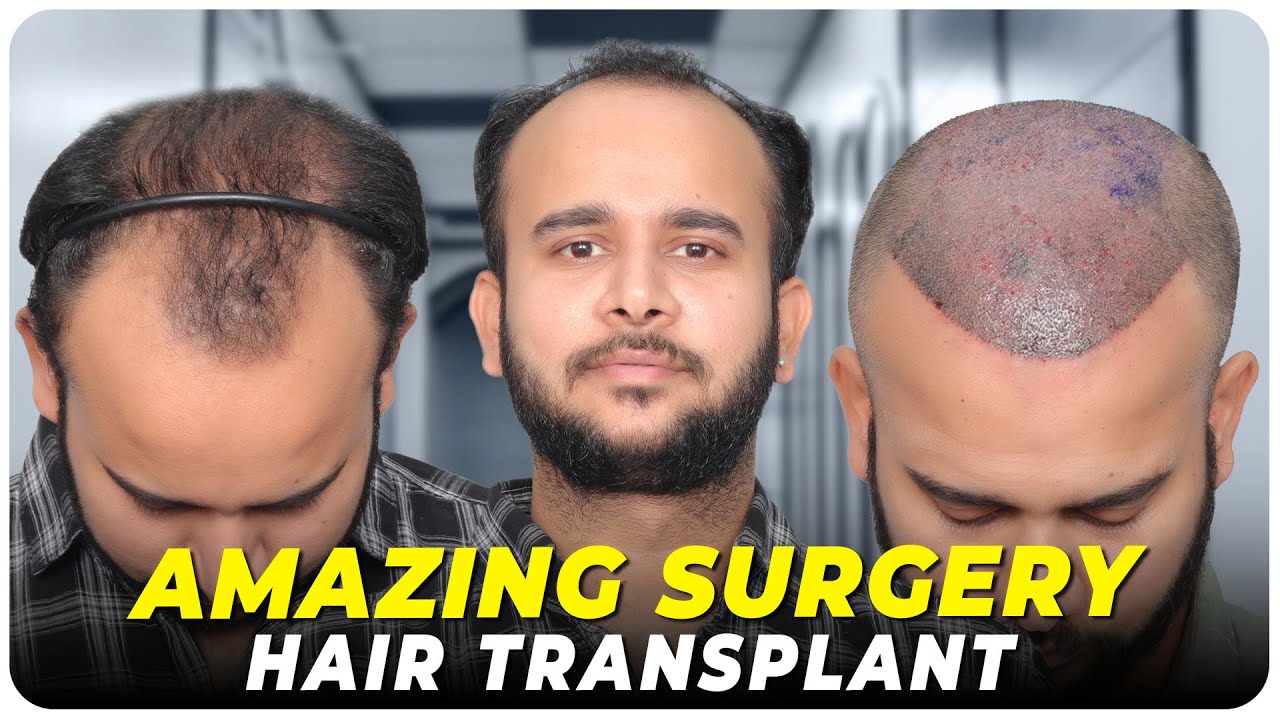 Hair Transplant in Sambalpur Best Results & Cost of Hair Transplant