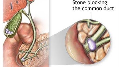 Choledocholithiasis & Cholangitis
