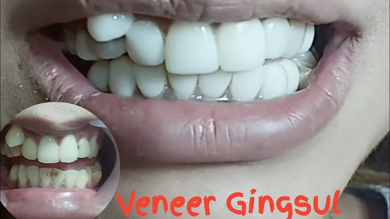 Veneer Gingsul Gigi (before after) YouTube