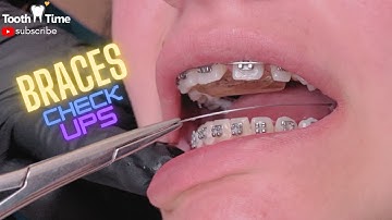 Braces On |UPDATE| 6 Months of braces journey - Tooth Time Family Dentistry New Braunfels
