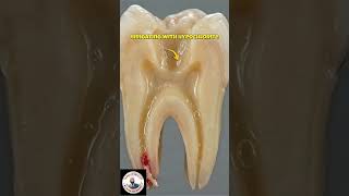 😱 Fear of Dental Treatment, Dant Dard Ka Ilaj, RCT Treatment, Root Canal Treatment #teethdecay #asmr