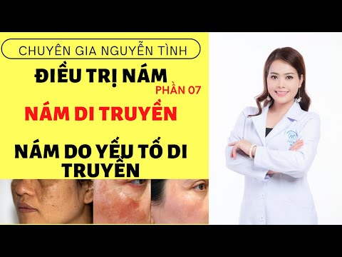 Cách điều trị nám, nám di truyền, nám định tính - Nguyen Tinh Official