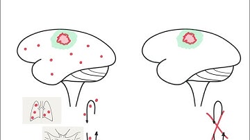 Brain Metastases versus Brain Tumors