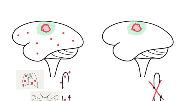 Brain Metastases versus Brain Tumors