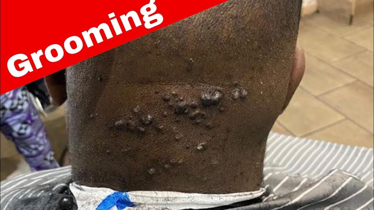 Bouton derrière la tête depuis plus d