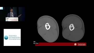 Alessandro Napoli - Mrgfusin The Management Of Osteoid Osteoma 2018
