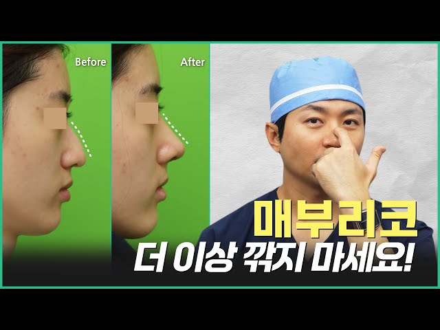 매부리코 수술의 최신기법. 위에서부터 깎지 않죠~