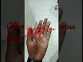 After division of cross fonger flap