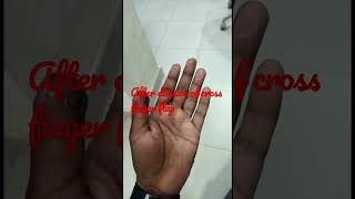 After division of cross fonger flap