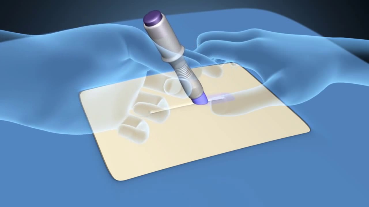 SurgiSeal Stylus® Topical Skin Adhesive - YouTube