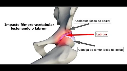 Como classificar a osteoporose?