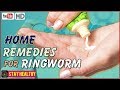 9 Home Remedies For Ringworm In Humans