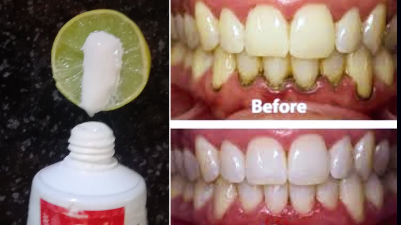 മഞ്ഞ നിറമുള്ള പല്ല് വെളുത്ത നിറമാക്കാം Teeth Whitening Tips