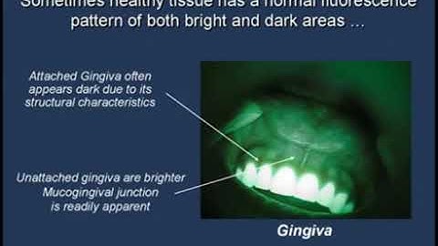 Fluorescence Visualization in the Normal Oral Cavity