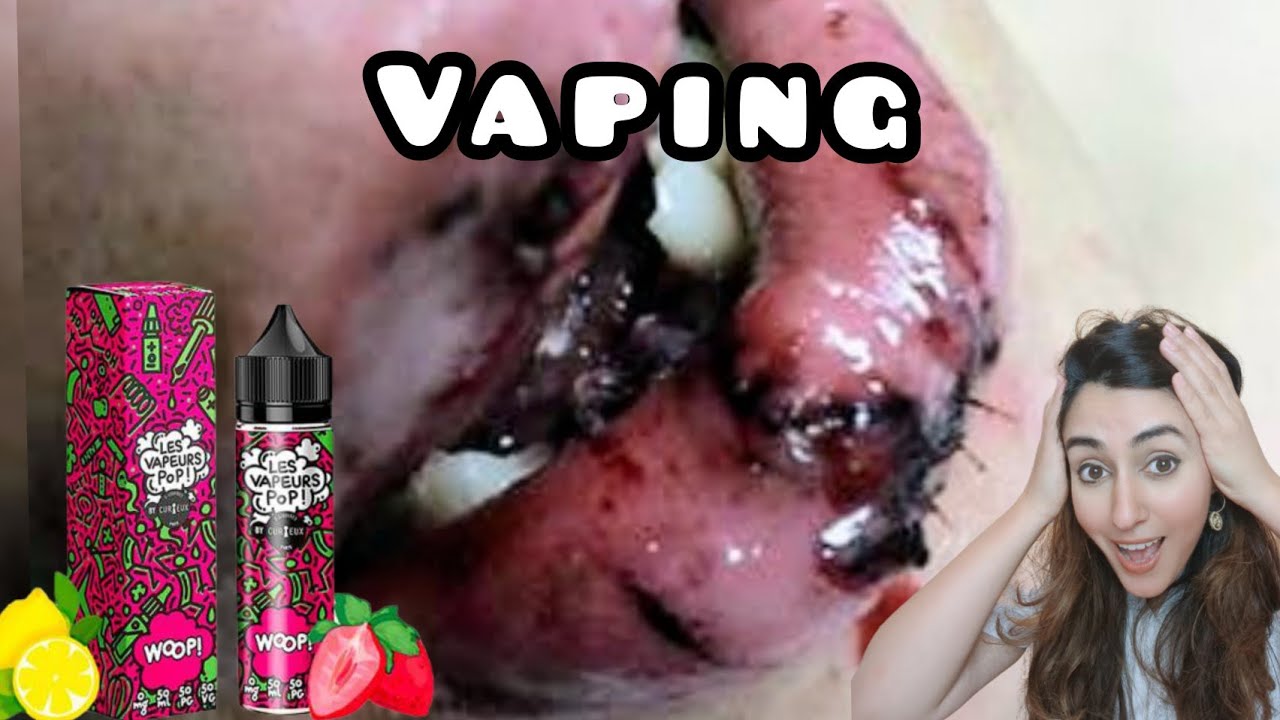 vape juice in mouth Vaping Risks - What Can Vaping Do To Your Mouth, Teeth, Braces & Invisalign Choose Flavor:Blue Razz Roll Up (discontinued) Category_Vape Kits best voltage for weed