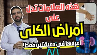 هذه العلامات تدل على الاصابة بامراض الكلى | اعرفها في دقيقتين فقط !