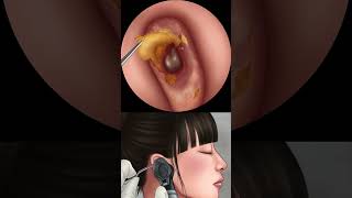 Asmr Remove Long Standing Earwax Blockage