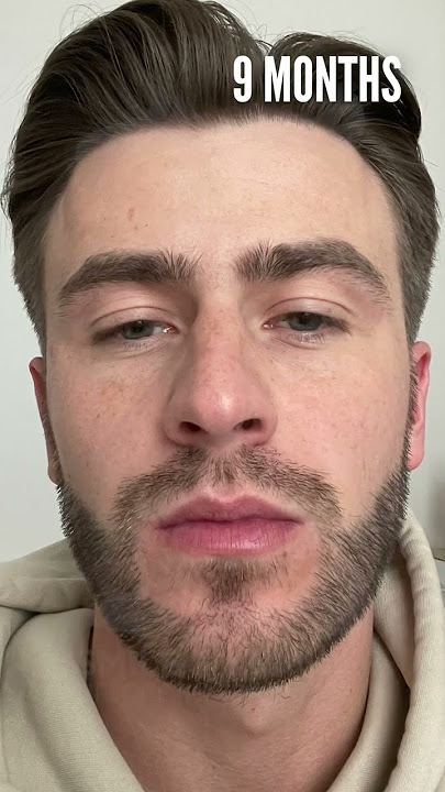 Beard Transplant - 9 Months Result of Liam!