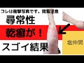 難病尋常性乾癬は塩と水とミネラルで良くなる！？【ビフォーアフター写真あり】
