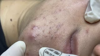 The best acne squeezing collection form Linh Mun Spa part 12