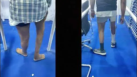 Knee ankle foot orthosis(Anterior support) with Becker drop lock knee joint(USA)-For polio patients.