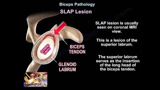SLAP Lesion - Everything You Need To Know - Dr. Nabil Ebraheim