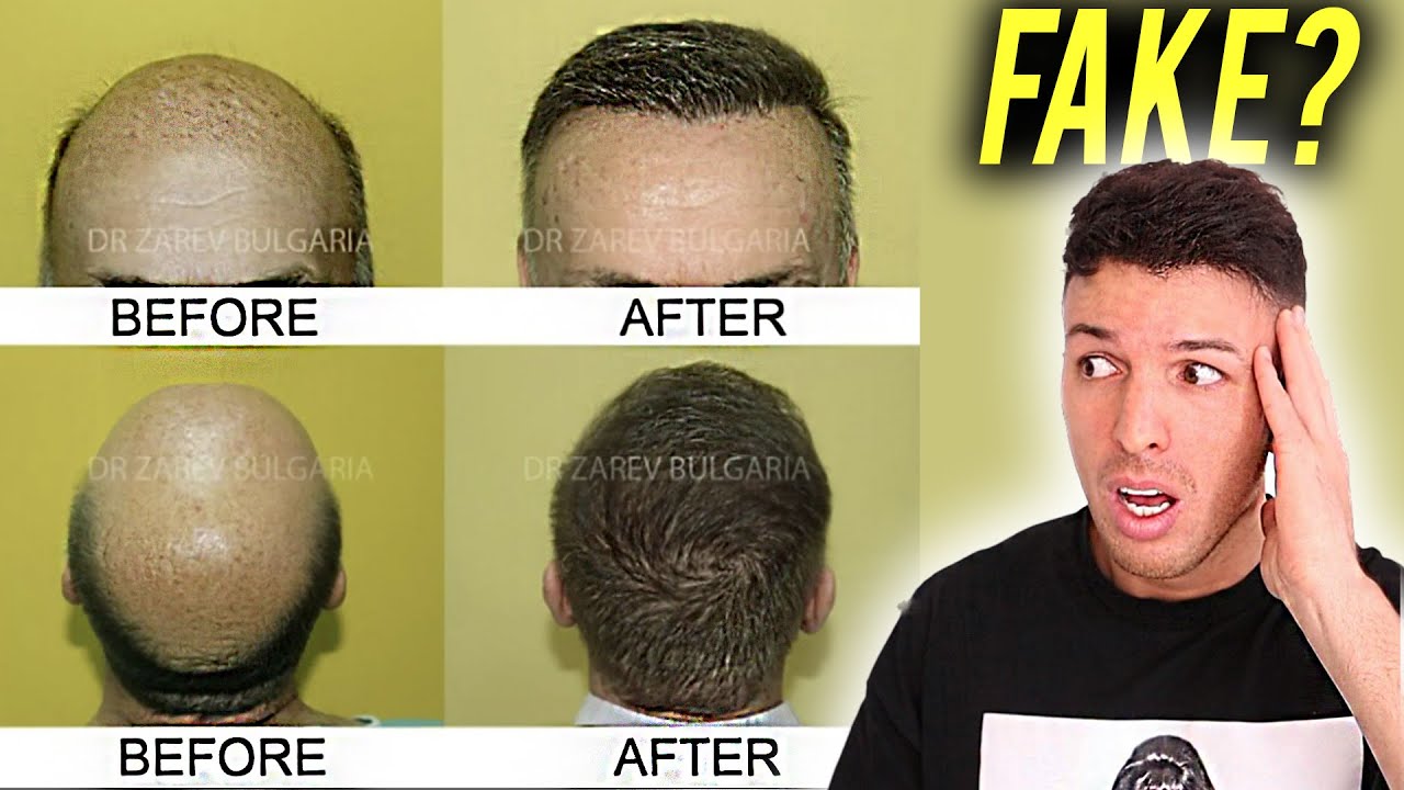 É IL MIGLIORE AL MONDO PER IL TRAPIANTO DI CAPELLI? - DR. ZAREV