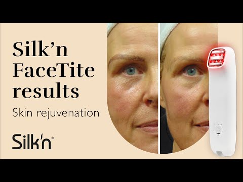 Silk'n FaceTite - Skin rejuvenation - Before and After