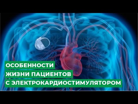 Видео: Может ли кардиостимулятор быть стимулятором?