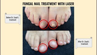 Fungal Nail Transformation With Laser Treatment