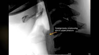 case 523 Foreign body swallowing pin in upper pharynx