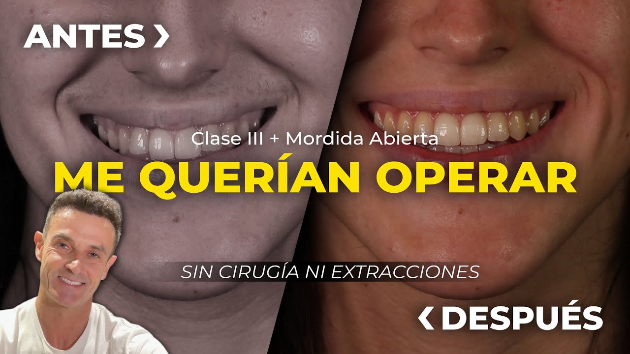 Clase III y Mordida Abierta: Cómo Evitamos Cirugía Ortognática y Extracciones