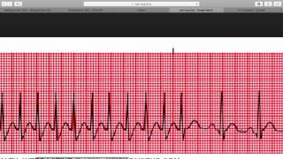 Paroxysmal Supraventricular Tachycardia Psvt