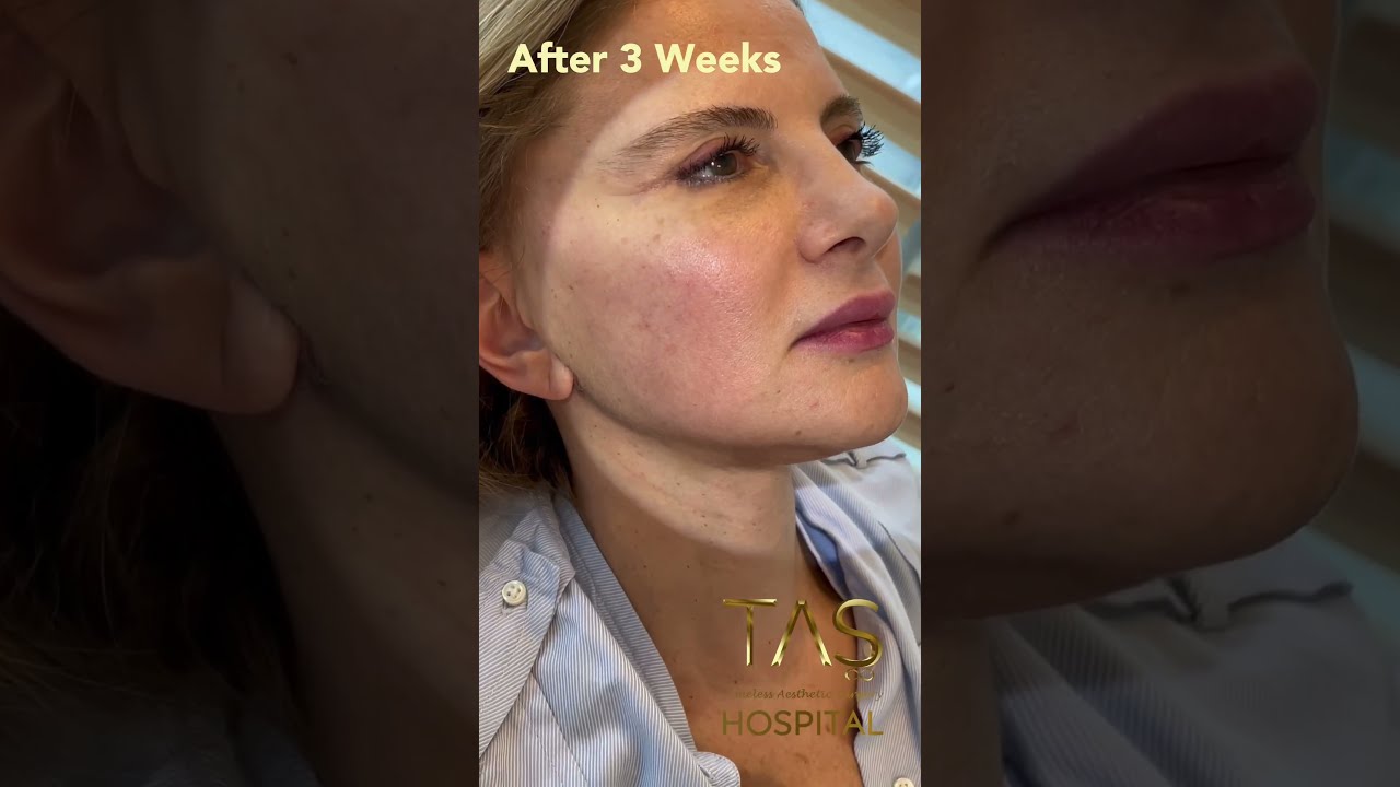 30 Years Back With Scarless Facelift By Dr Suleyman TAS