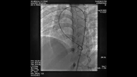 1 Perimembranous VSD Device Closure   LV Angiogram