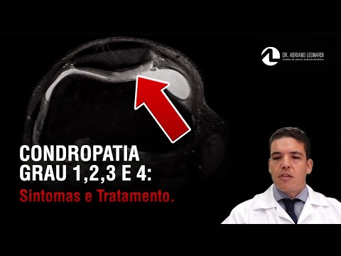 Condropatia grau 1, 2, 3 e 4: sintomas e tratamento