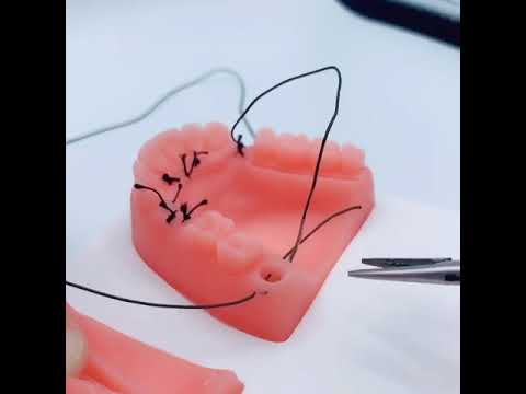 Sutures For Wisdom Tooth Removal 