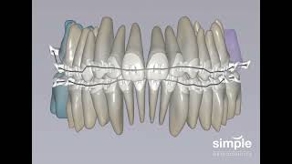 Dr. Sean K. Carlson from Simple Orthodontics in Marin demonstrates high-tech braces.