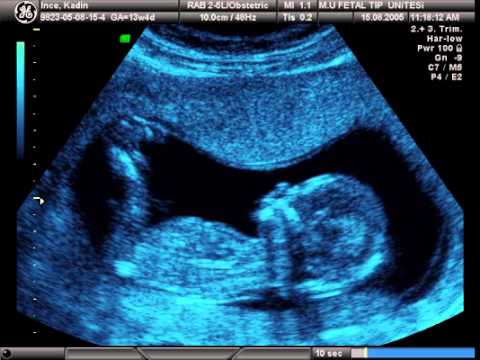 13 haftalık gebelik ve 2D ultrason.