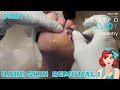 Calluses &amp; Hard Skin Removal|Αφαίρεση κάλων|Κέντρο Ποδιού Podiatry|Podiastrist|Ποδίατρος|Ποδολόγος