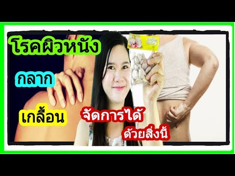 โรคผิวหนัง กลาก เกลื้อน หายได้ง่ายๆโดยใช้กระเทียม ทดลองทำดูเลย| MAMTUM Family