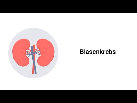 Video: Die Vorherrschende Globale Glomerulosklerose Bei Patienten Mit Urothelkarzinom Der Oberen Harnwege Mit Vorbestehender Nierenfunktionsstörung Ist Ein Prädiktor Für Schlechte Nierene