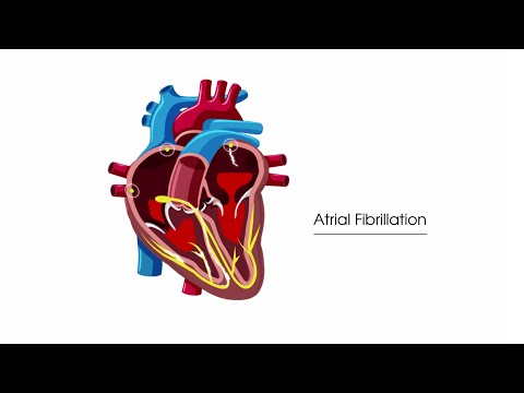 Get an ECG, older folk – you might have atrial fibrillation