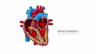 What is atrial fibrillation?